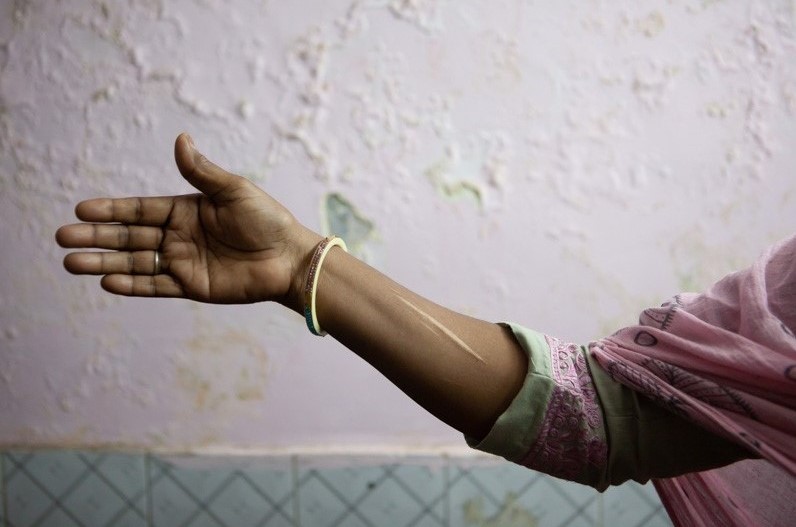 A woman who uses drugs receives support at WINGS Delhi woman's arm with scar