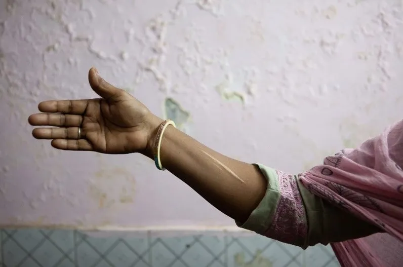 woman's arm with scar 